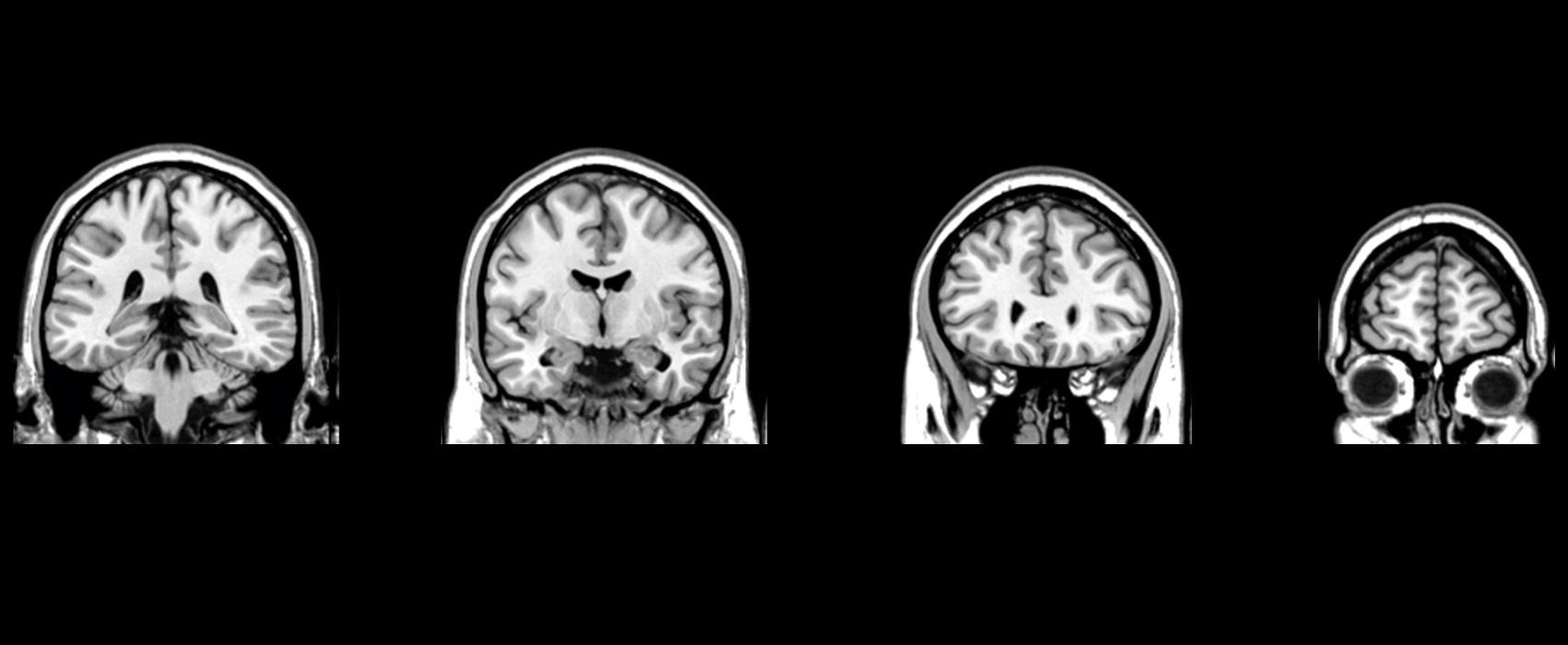 imagem de Cannabis e cérebro, uma relação mal explicada