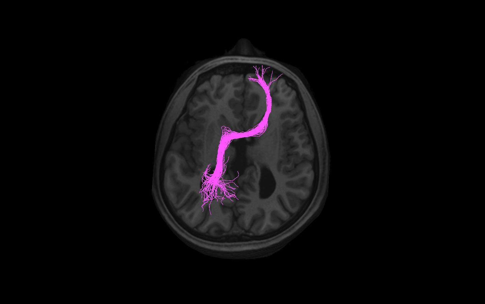 imagem de Disgenesia do corpo caloso é tema de evento em Salvador