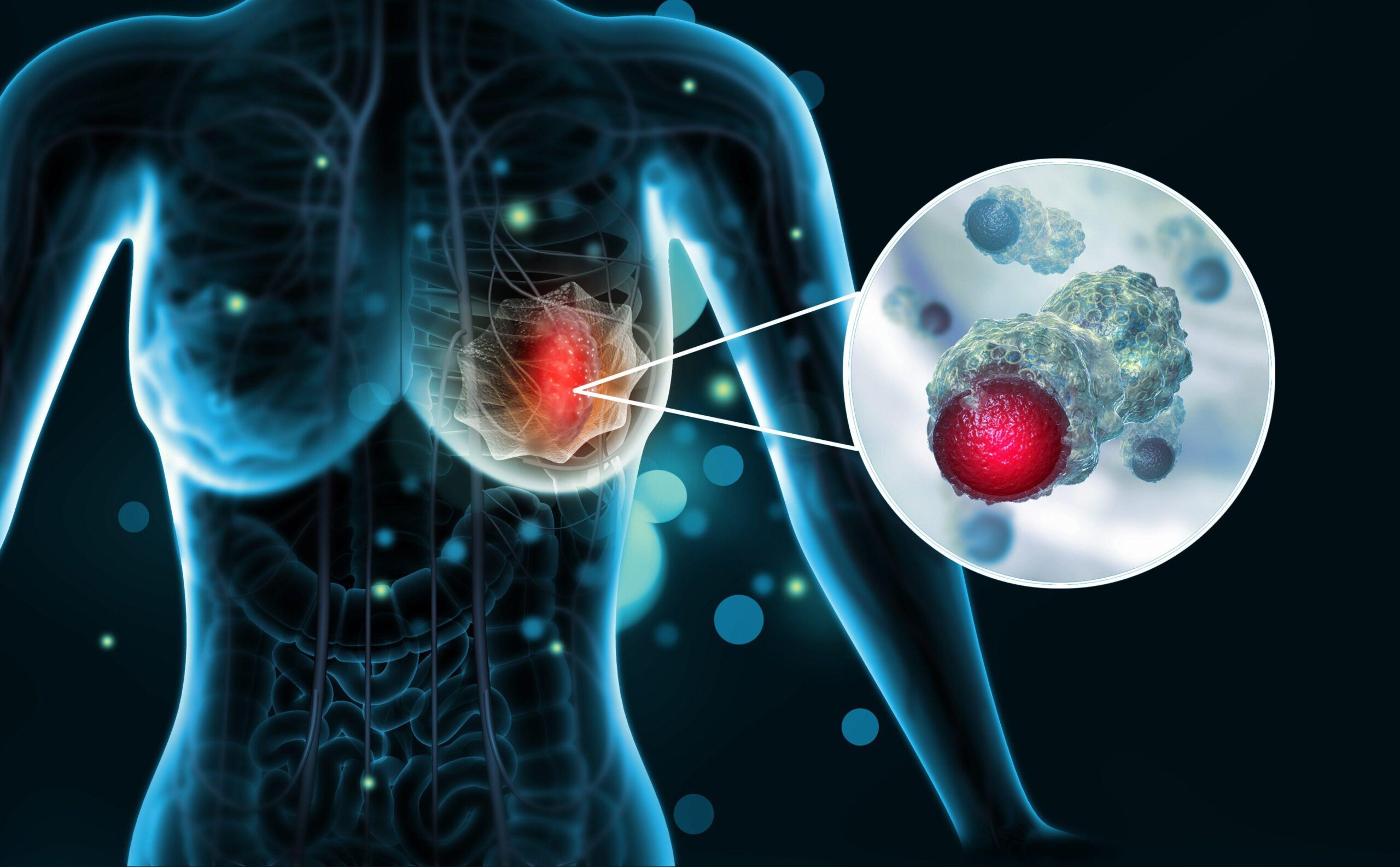 Estudo com a participação do IDOR analisa síndrome genética como fator prognóstico para o câncer de mama