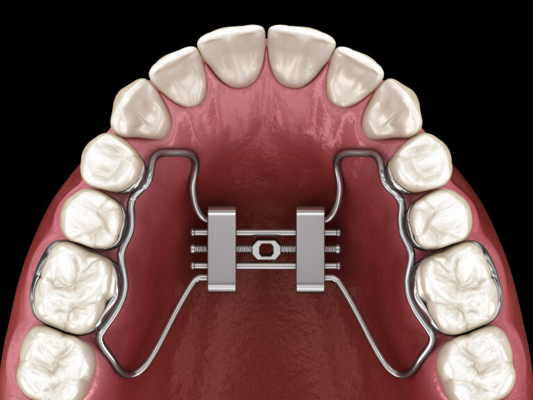 imagem de Novo curso de curta duração do IDOR: Expansão Endoscópica da Maxila para tratamentos de distúrbios respiratórios.