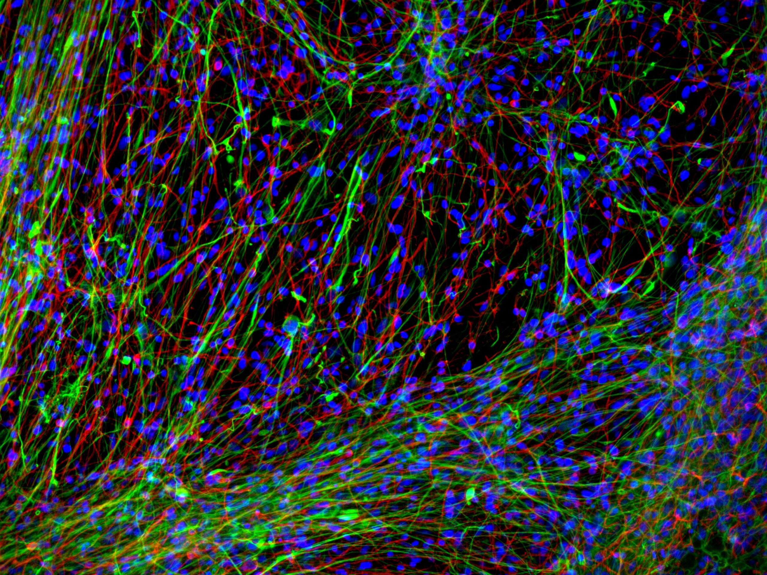 imagem de “Big Brother” celular: modelo 3D com células humanas permite observar metástases cerebrais em tempo real e abre caminho para novos tratamentos