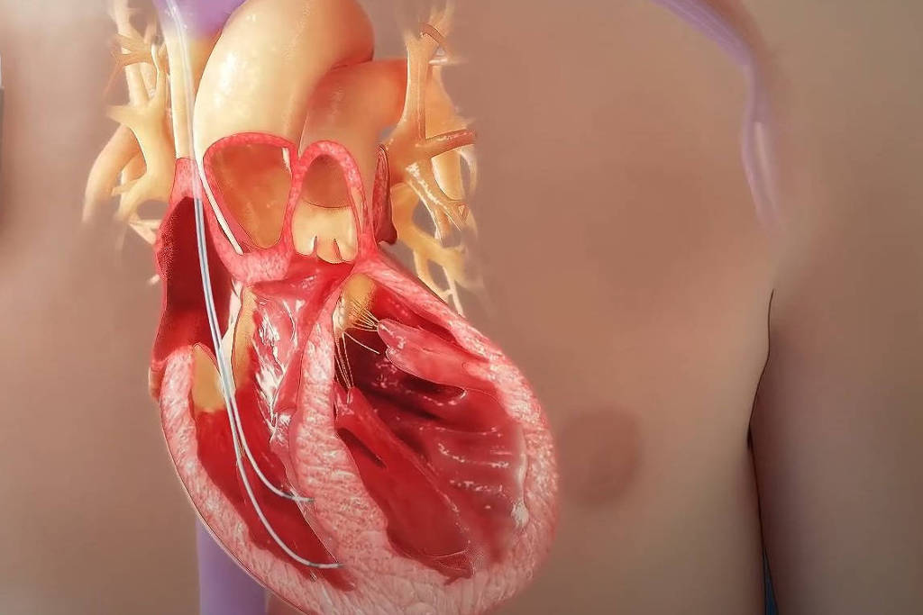 imagem de Folha: Pesquisa brasileira aponta novos alvos terapêuticos para fibrilação atrial